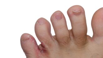 Fußpilz: Behandlung im Überblick | Fusspilz